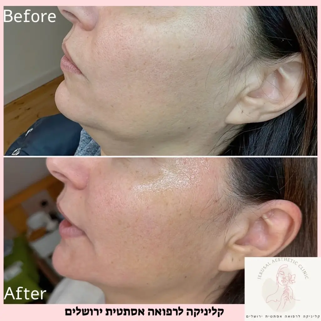 עיצוב קו לסת שליש תחתון גילאי 50