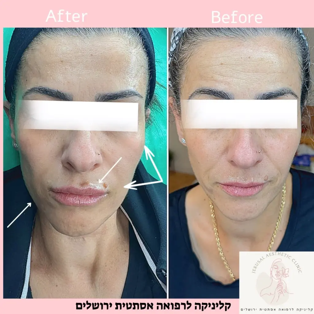 מילוי לחיים ומילוי קמטי הנזולביאל
