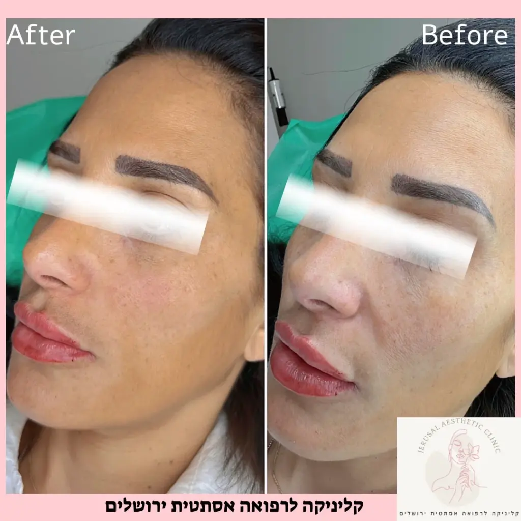 מילוי עצם לחי קדמית להשבת נפח מיידי