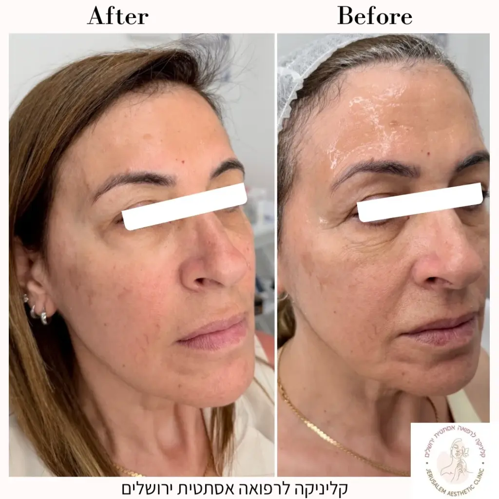 מילוי עצם לחי קדמית מילוי הנזולביאלבאמצעות חומצה היאלרונית