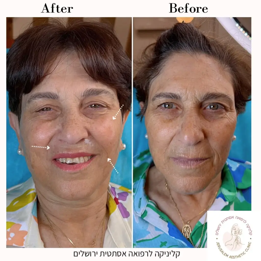 מילוי עצם לחי קדמית מילוי הנזולביאל-מילוי ברקוד (קמטי עישון)באמצעות חומצה היאלרונית