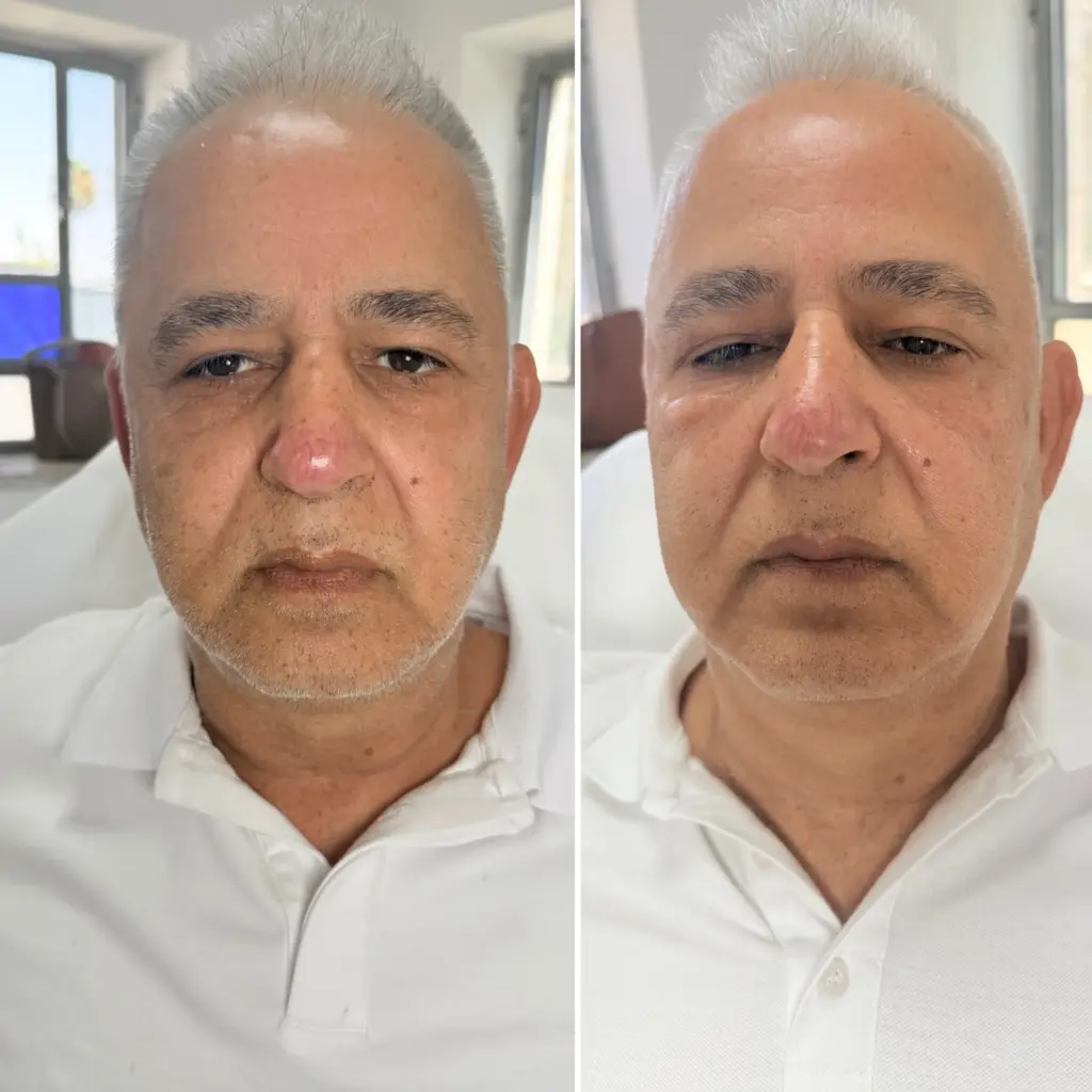 אסטפיל – מתיחת פנים טבעית - תמונה 23