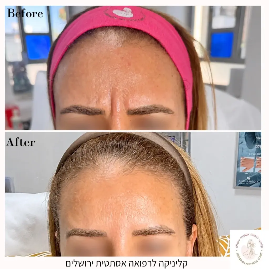 בוטוקס בין הגבות לפני אחרי
